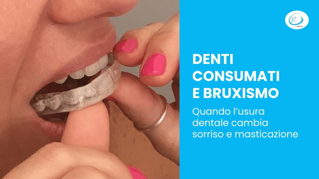 Denti consumati e bruxismo