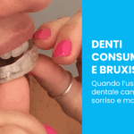 Denti consumati e bruxismo