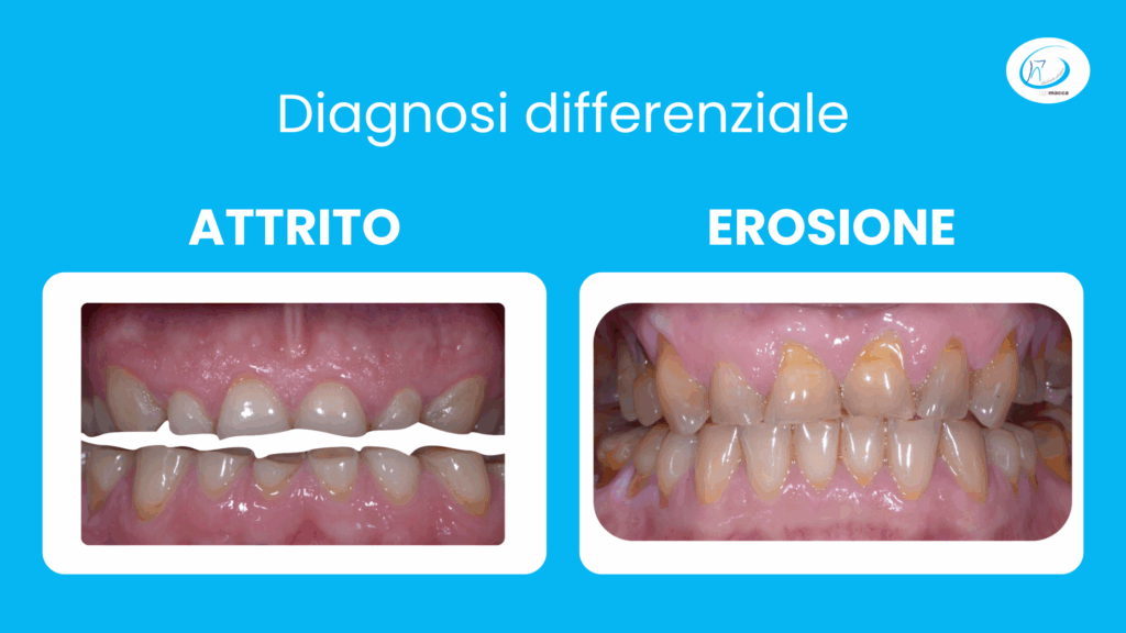 Diagnosi differenziale: attrito ed erosione dentale