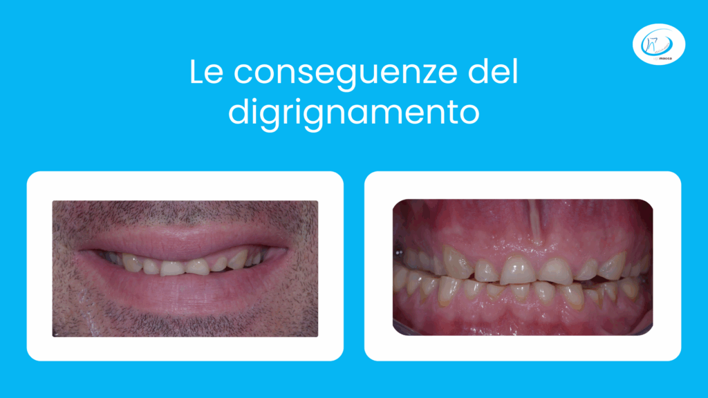 Le conseguenze del digrignamento