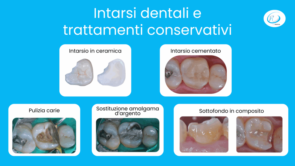 Intarsi dentali e trattamenti conservativi