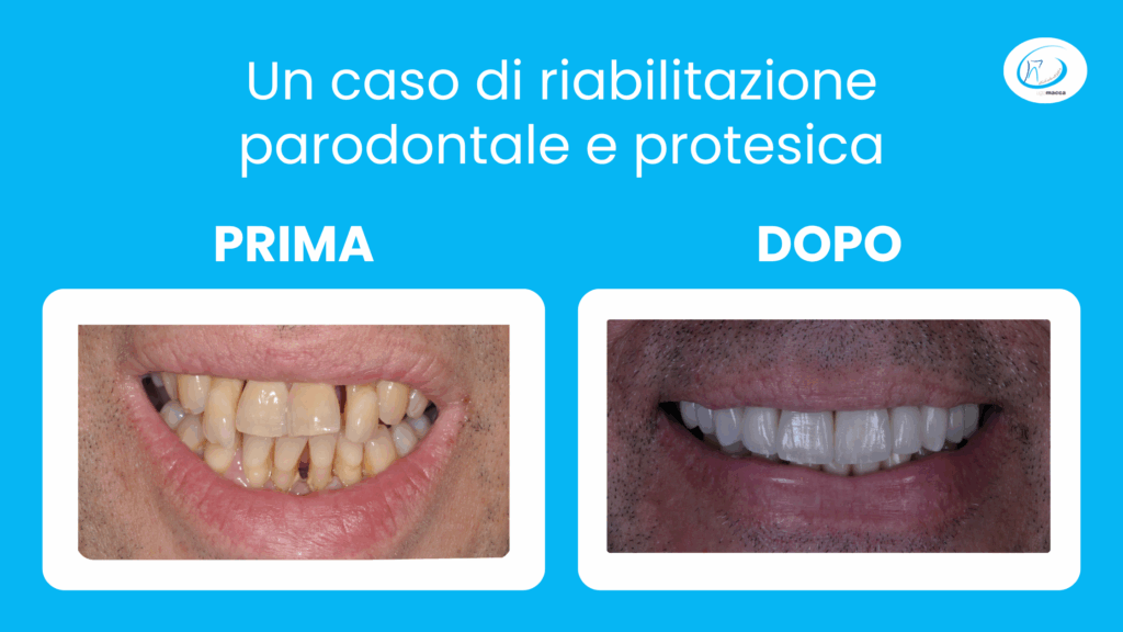 Un caso di riabilitazione parodontale e protesica - Studio dentistico Ugo Macca