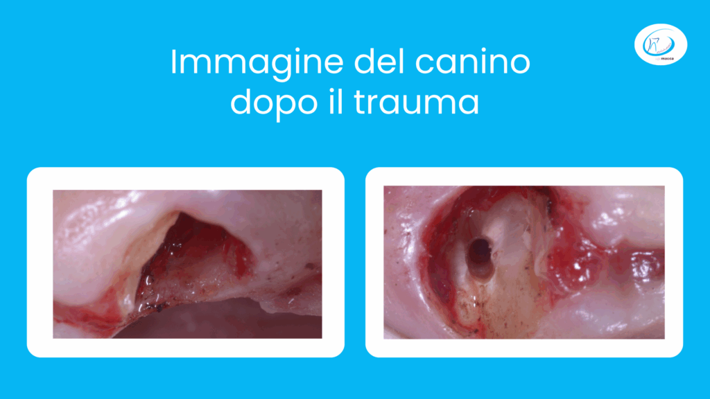 Immagine del canino dopo il trauma - Studio dentistico Ugo Macca
