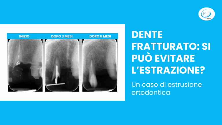 Dente fratturato: si può evitare l'estrazione?