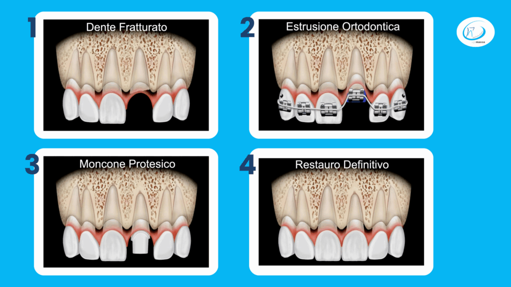 Disegni di un caso di estrusione ortodontica, dal dente fratturato al restauro definitivo - Studio dentistico Ugo Macca