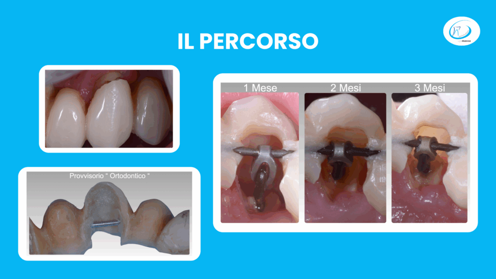 Il percorso di recupero del dente rotto - Studio dentistico Ugo Macca