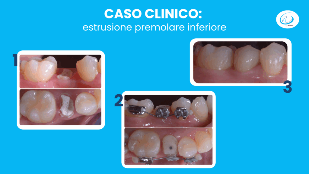 Un altro caso clinico: estrusione premolare inferiore - Studio dentistico Ugo Macca