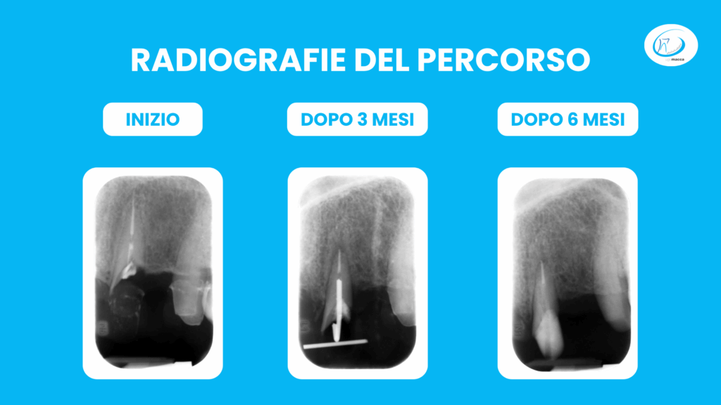 Radiografie del percorso di estrusione del dente - Studio dentistico Ugo Macca