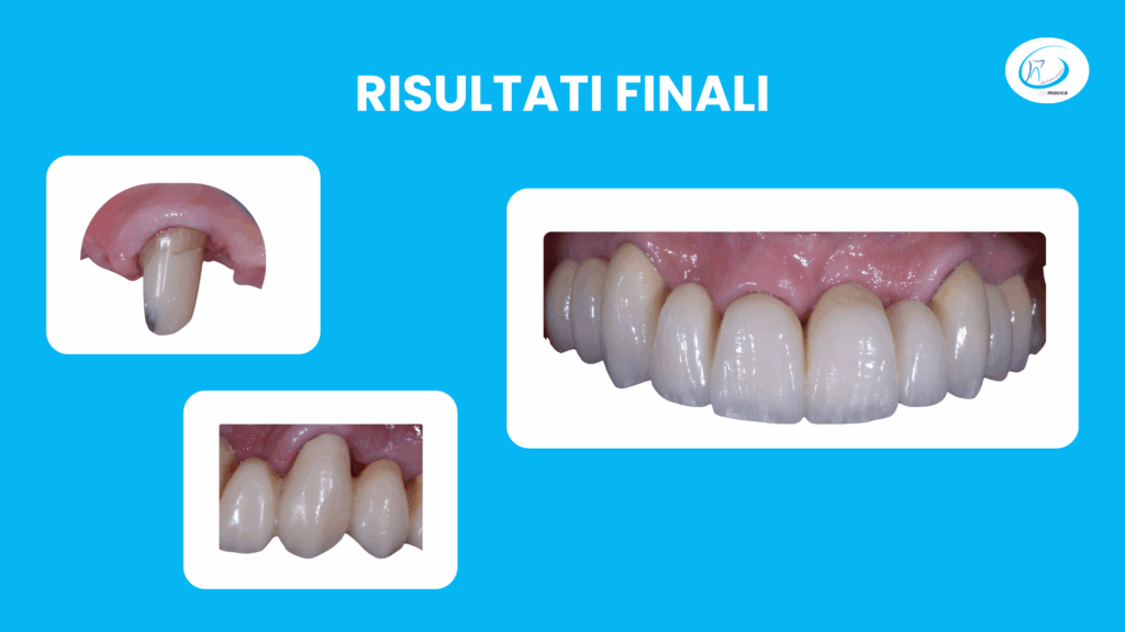 I risultati del percorso di estrusione e ricostruzione del dente - Studio dentistico Ugo Macca